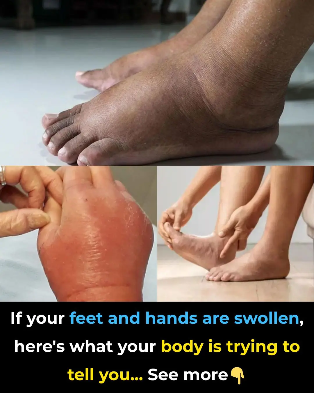 Foods that can ease swelling in hands and feet
