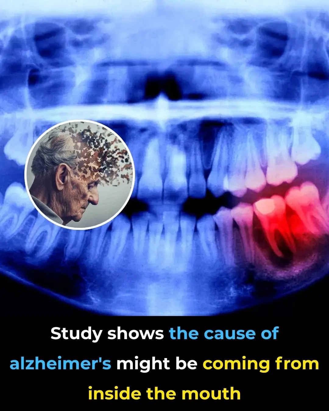 The cause of Alzheimer’s may lie within your mouth