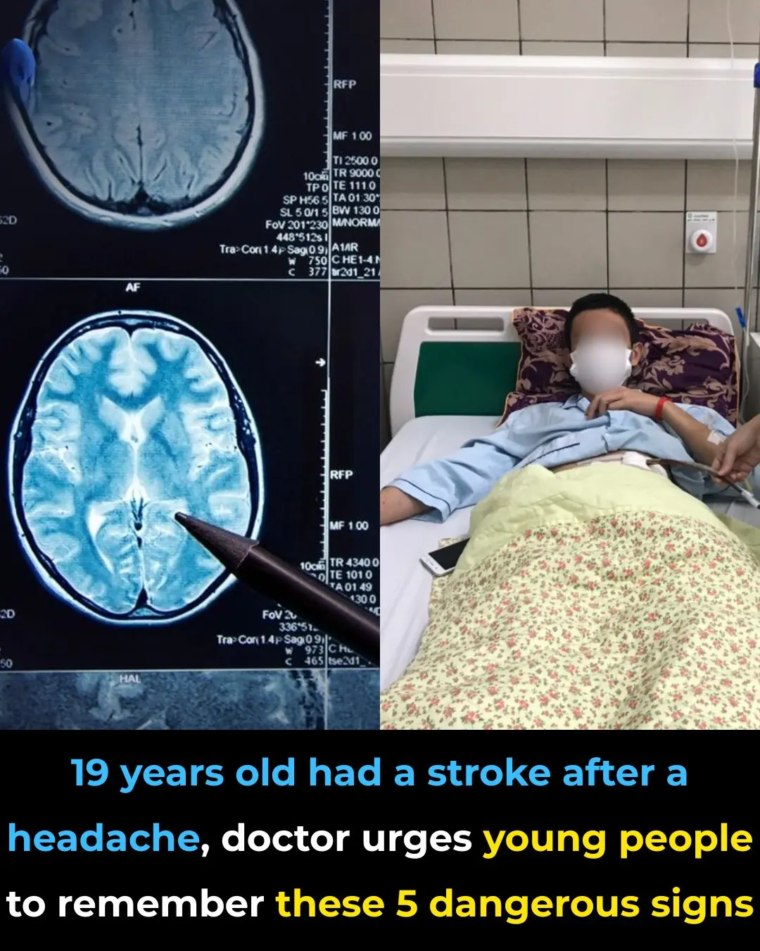 5 warning signs of stroke in young adults