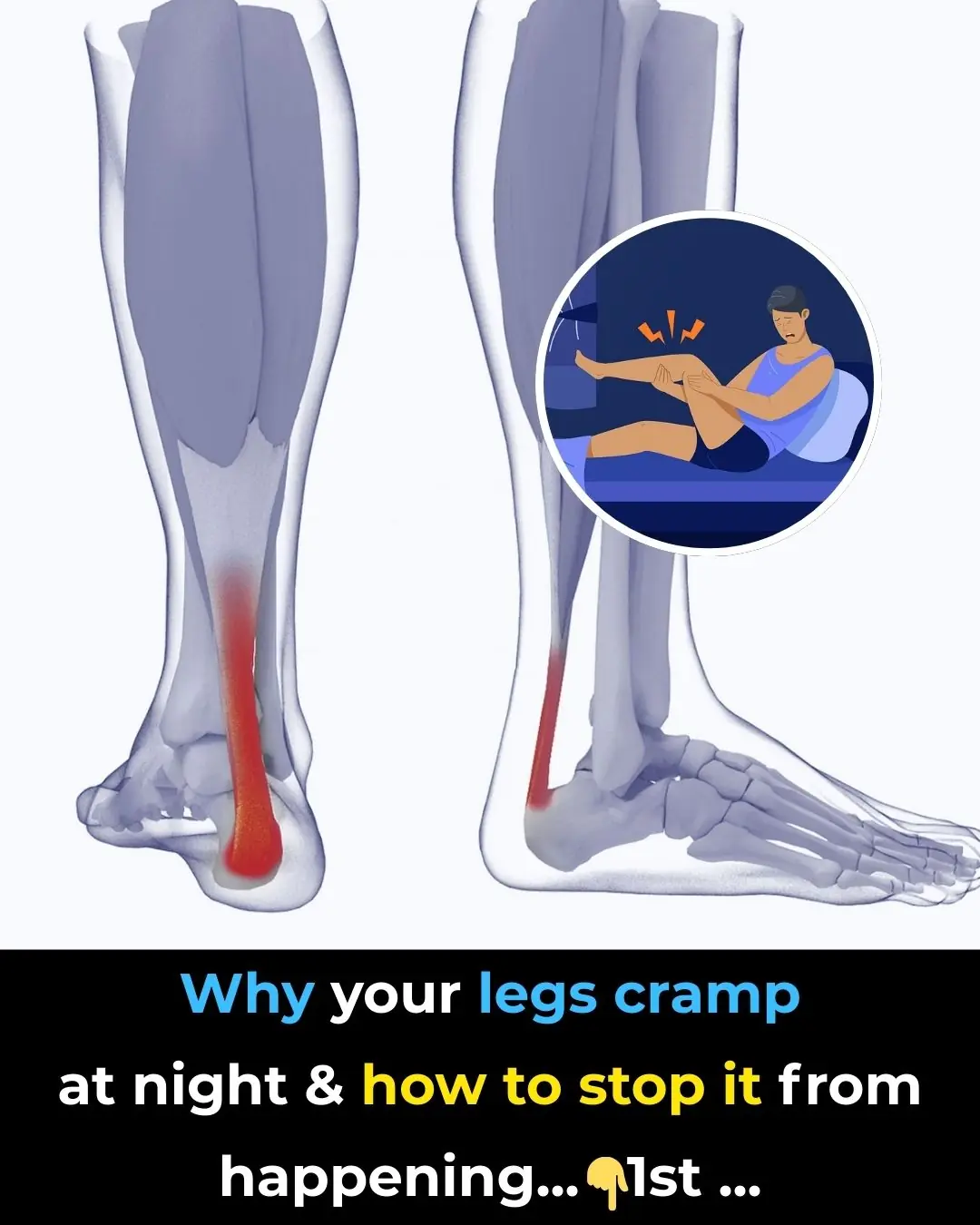 Why your legs cramp at night and how to stop it from happening