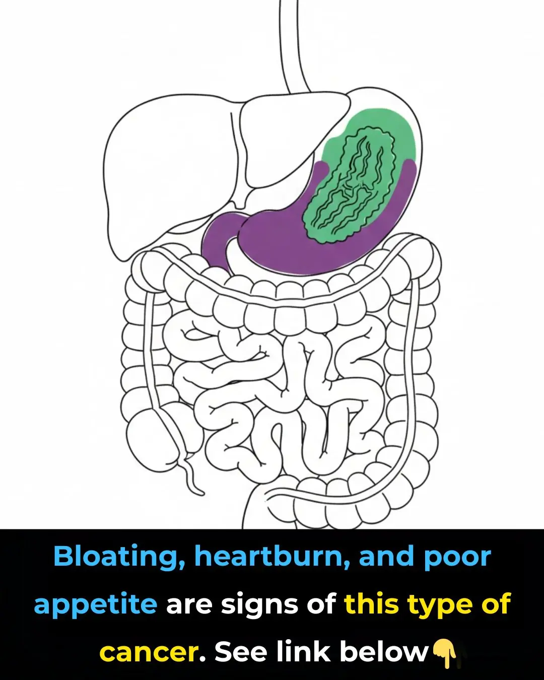 What Is Stomach Cancer?