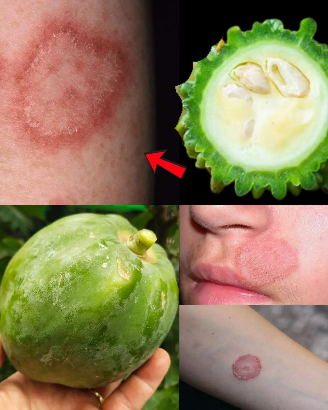 9 Powerful Home Remedies to Eliminate Fungal Infections (Daad, Khaj, Khujli) Naturally and Fast