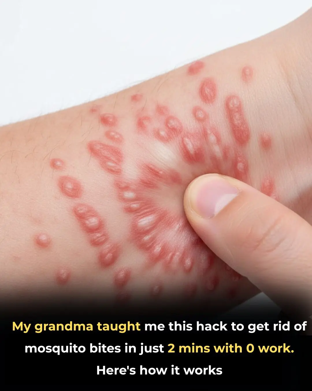 The Hot Spoon Hack for Mosquito Bites