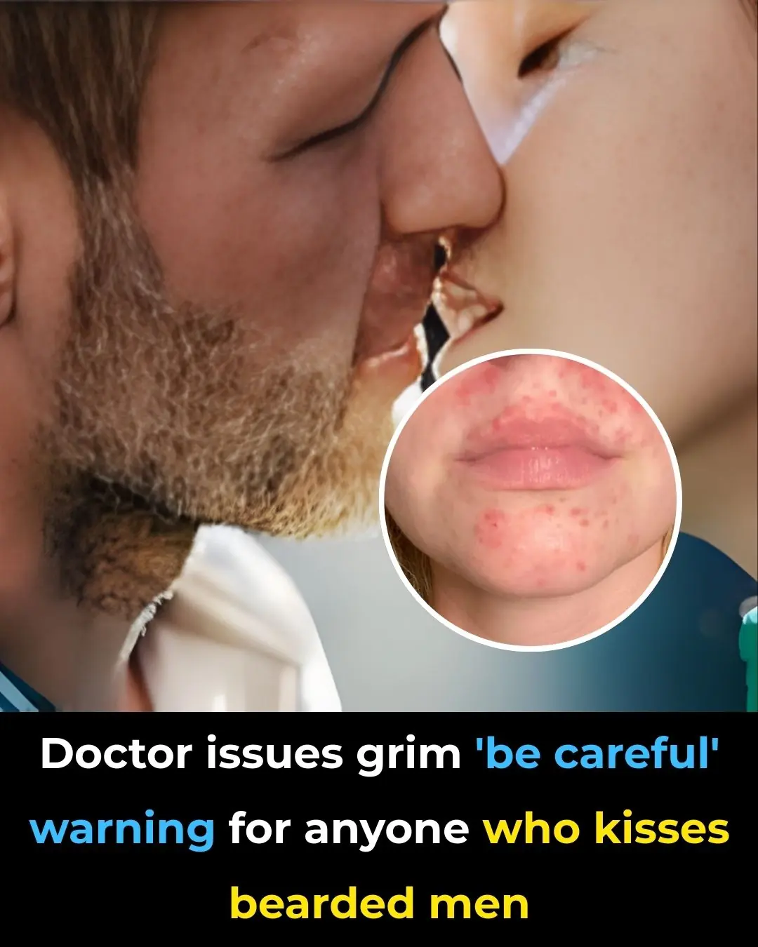 The Hidden Health Risks of Kissing A Bearded Man