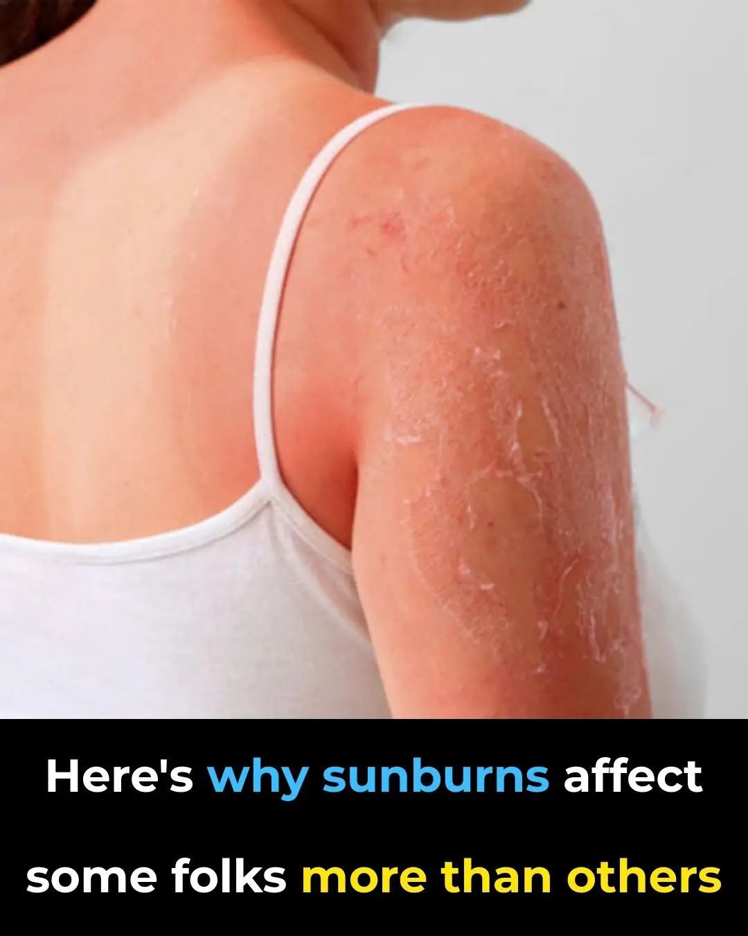 Why Some People Sunburn Easily