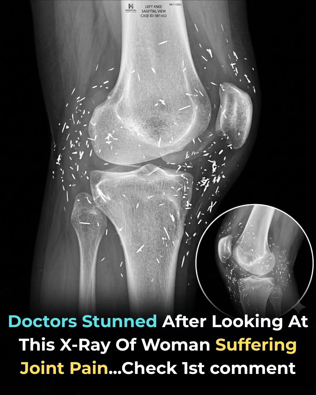 Doctors Stunned After Looking At This X-Ray Of Woman Suffering Joint Pain