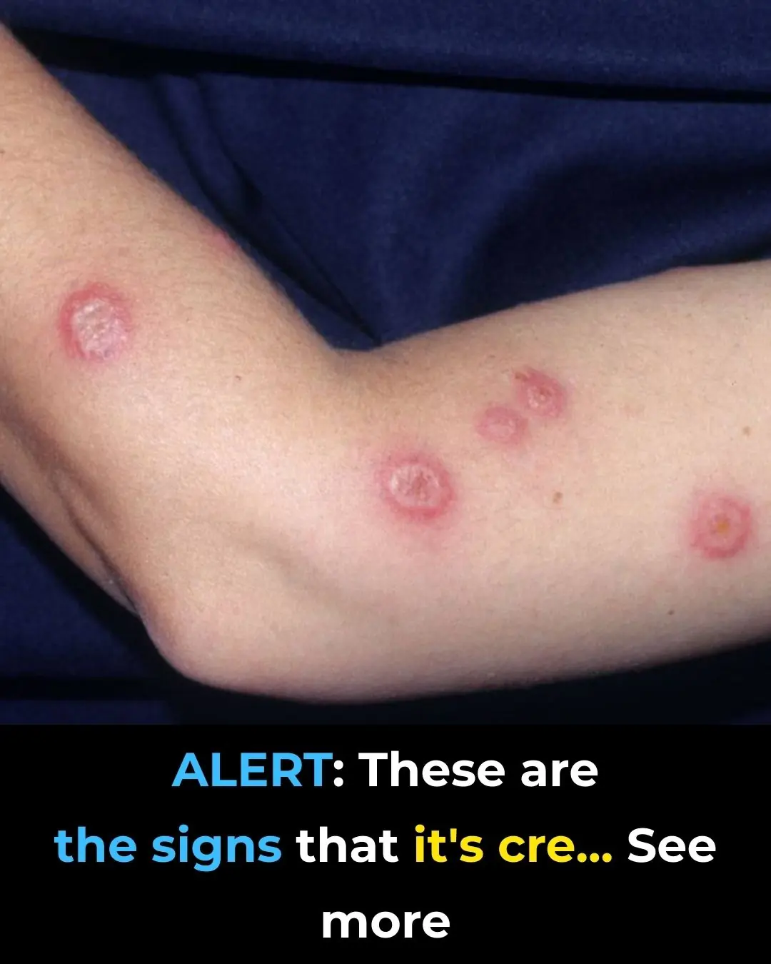 ALERT: These are the Signs of Sweet Syndrome