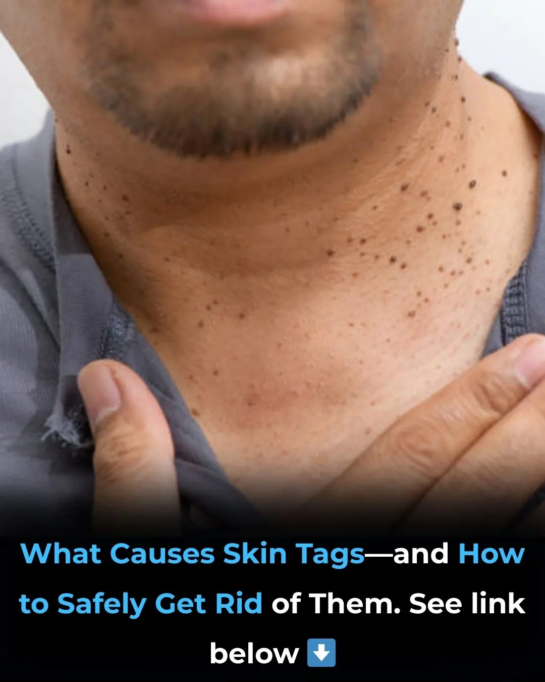 How To Identify Skin Tags and When To Remove Them