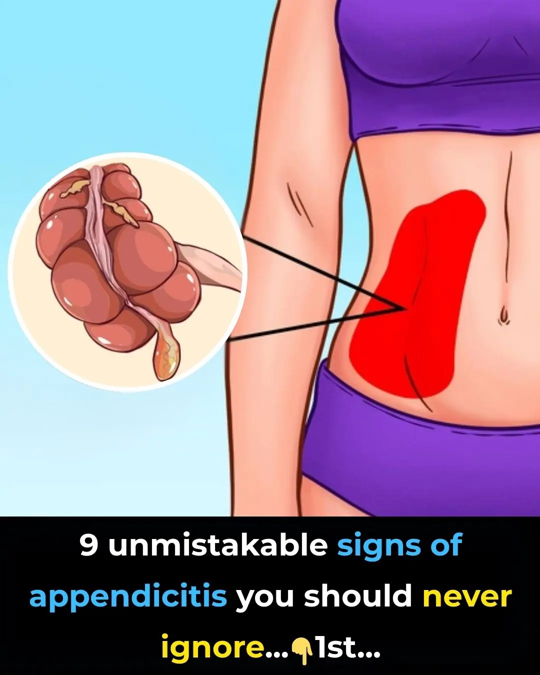 9 Unmistakable Signs Of Appendicitis You Should Never Ignore