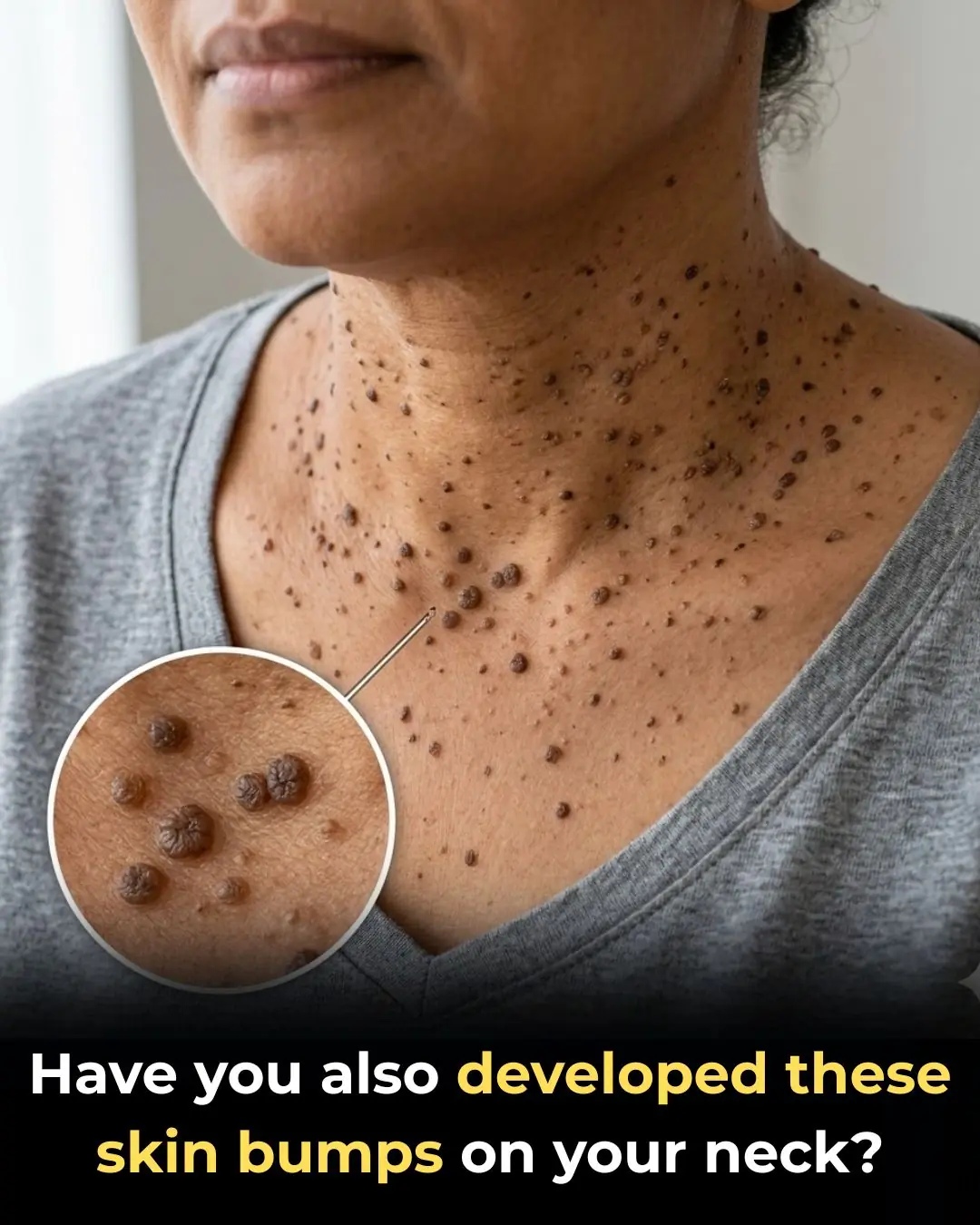 Have you also developed these skin bumps on your neck?