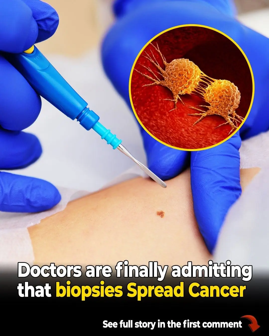 Can Biopsies Cause Cancer to Spread? Experts Explain the Risk