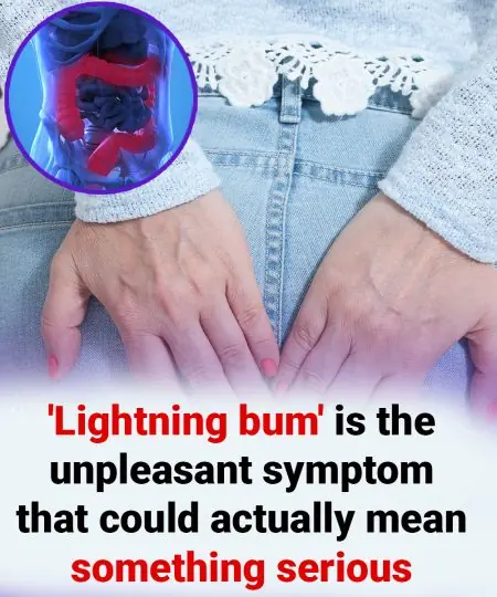 A Doctor Explains What “Lightning Bum” Really Is