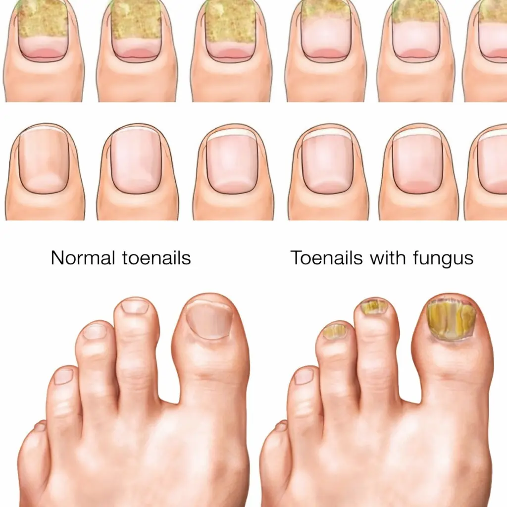 Say Goodbye to Stubborn Fungus: 7 Best Natural Remedies for Toenail Health