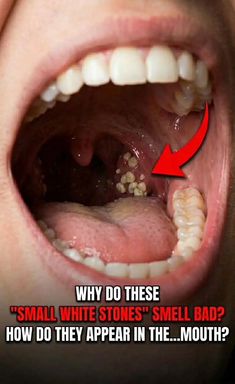 What Are Those Smelly White “Stones” in Your Mouth That Cause Terrible Bad Breath?