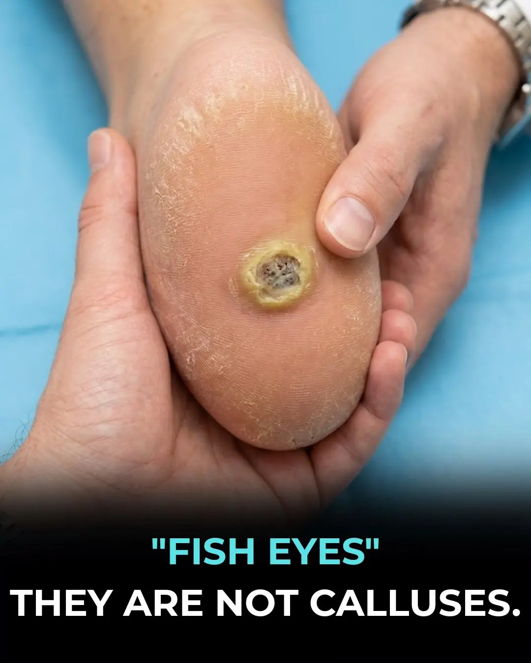 "FISH EYES" THEY ARE NOT CALLUSES...
