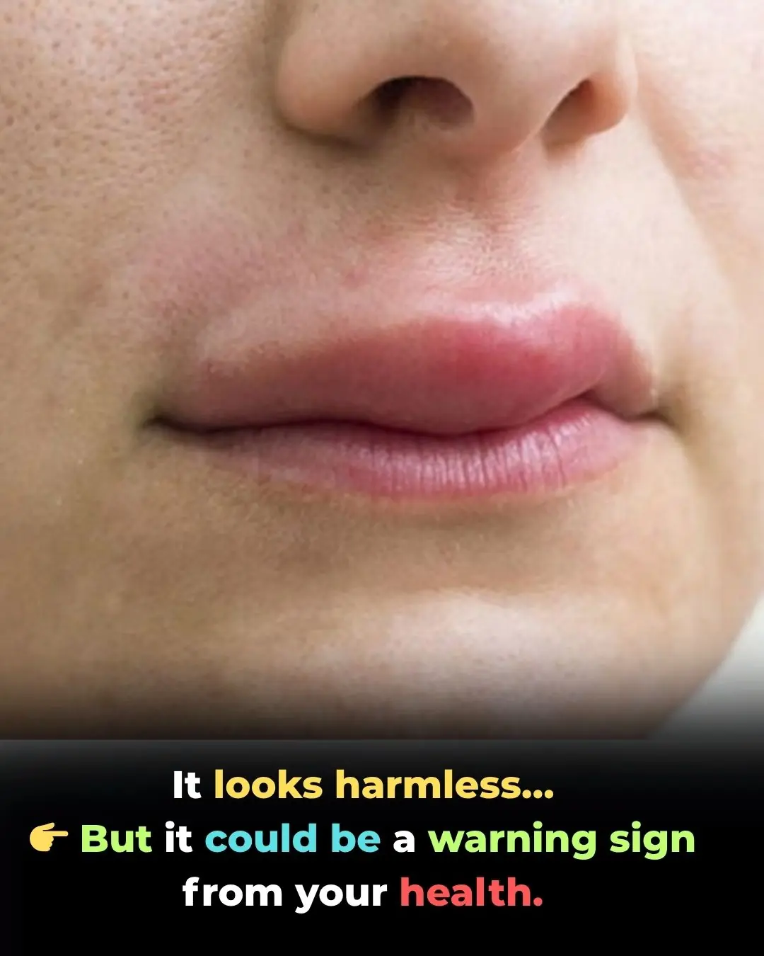 The Silent Reaction: A True Story of Drug-Induced Angioedema