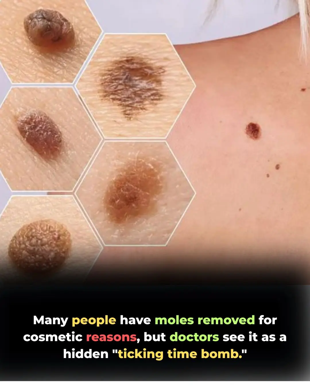 Is It Just a Beauty Mark? 3 Silent Warning Signs Your Mole Could Be Skin Cancer