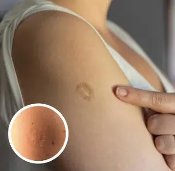 Here's The Truth Behind This Scar On People's Upper Left Arm