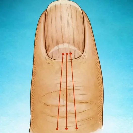 If you have lines on your nails, it means you have c...