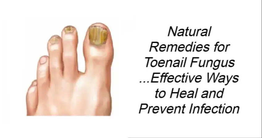 Natural Remedies for Toenail Fungus
