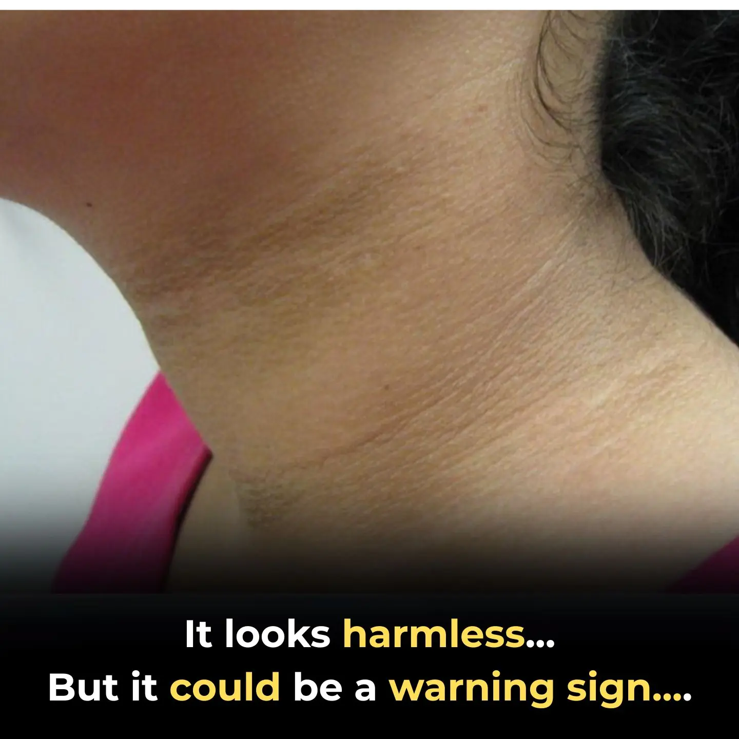 Why Your Dark Neck Isn't "Dirt": Understanding Acanthosis Nigricans