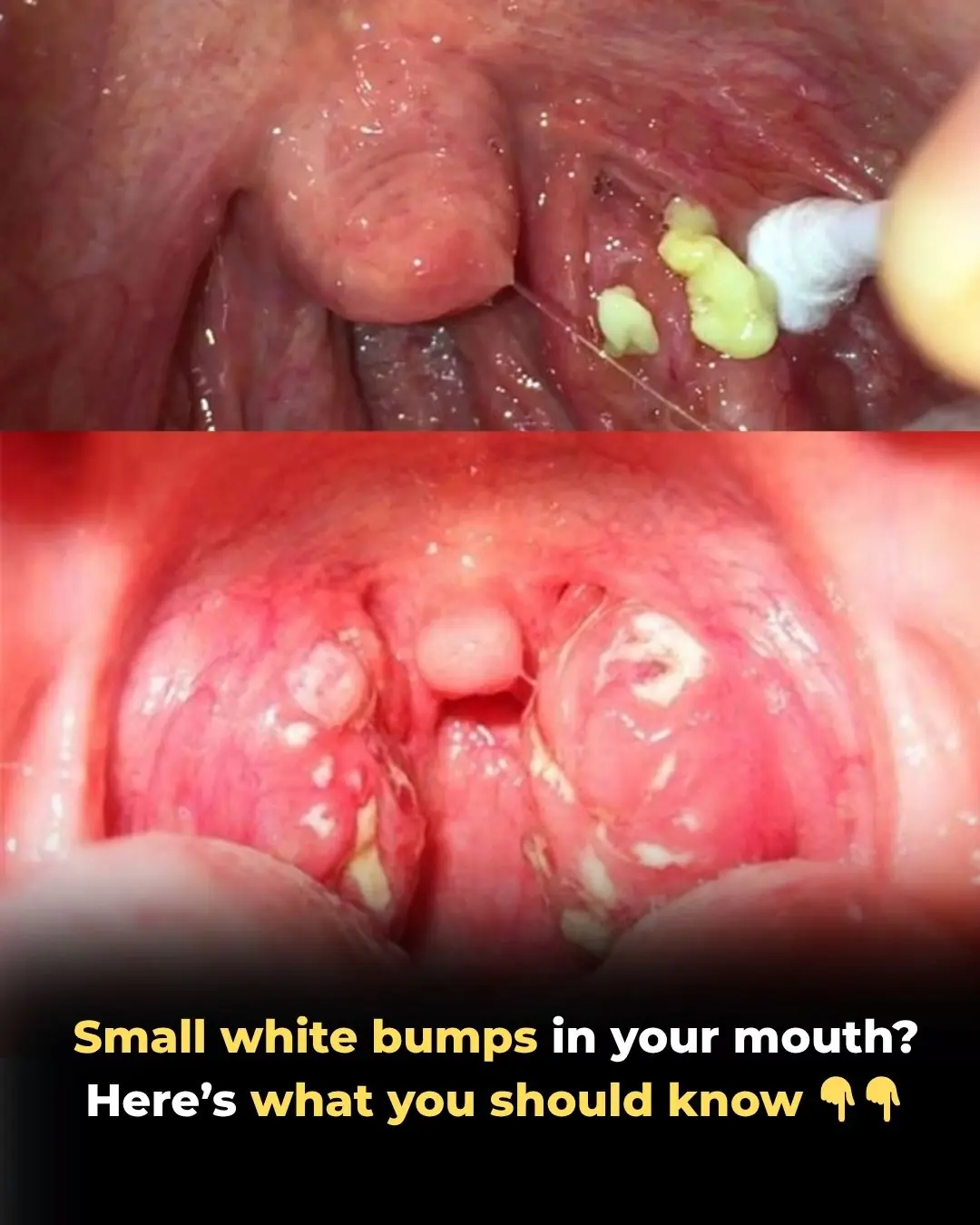 Tonsilloliths: A Comprehensive Clinical Overview of Tonsil Stones