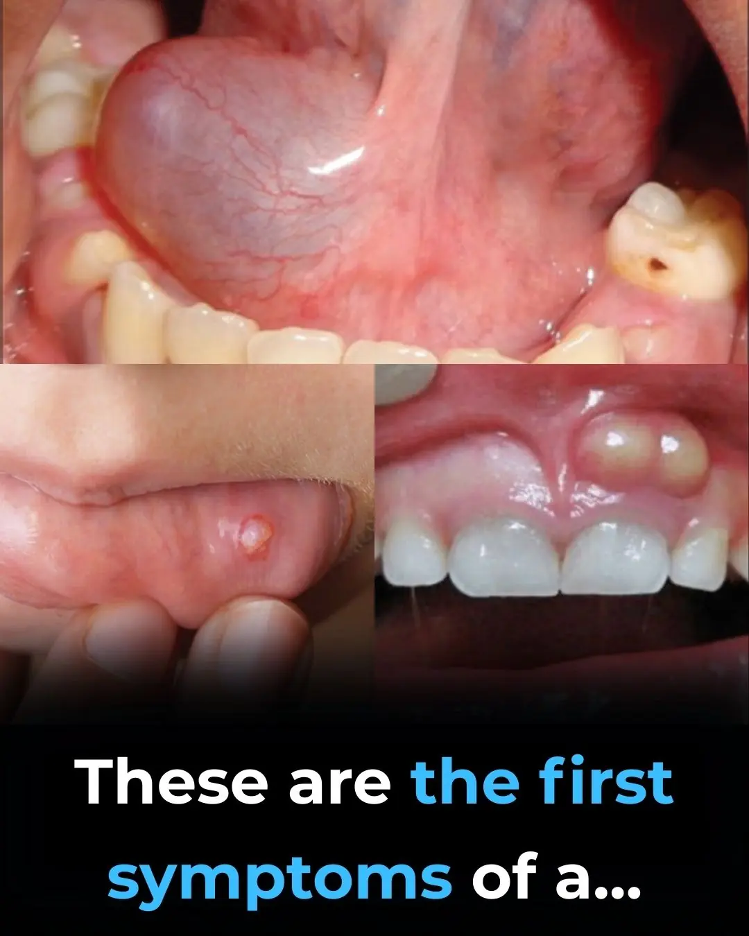 Hidden Dangers in Your Mouth: Early Signs of Oral Cancer