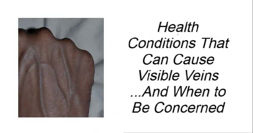 Health Conditions That Can Cause Visible Veins