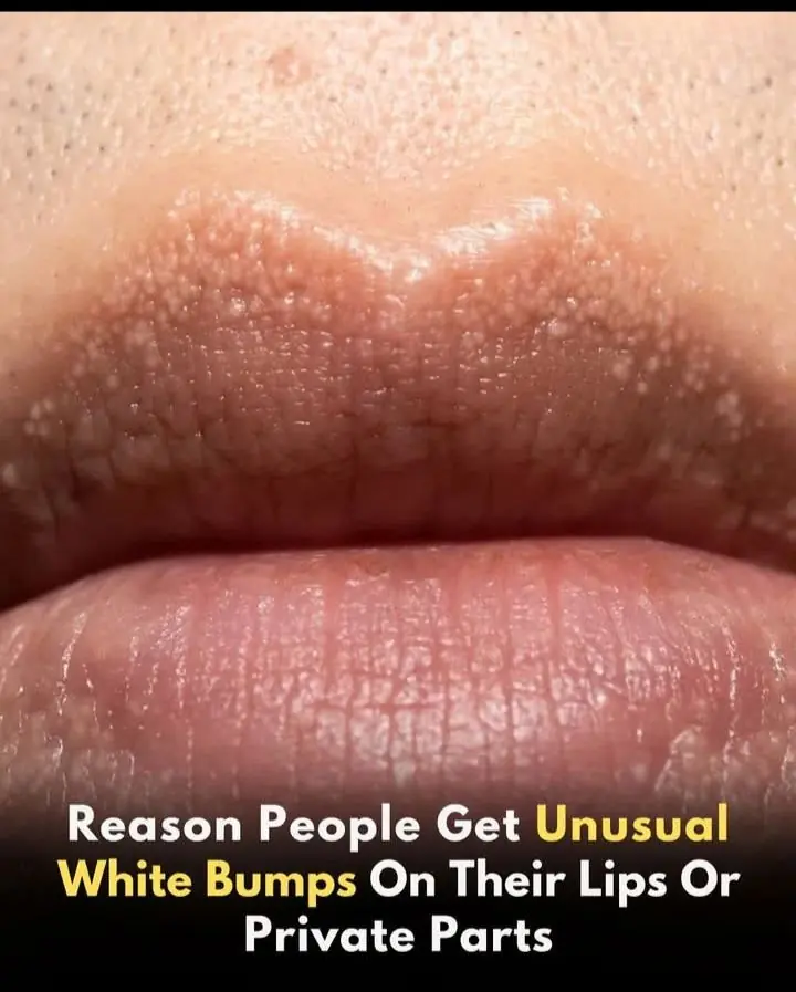 What Are Those White Bumps on Lips?
