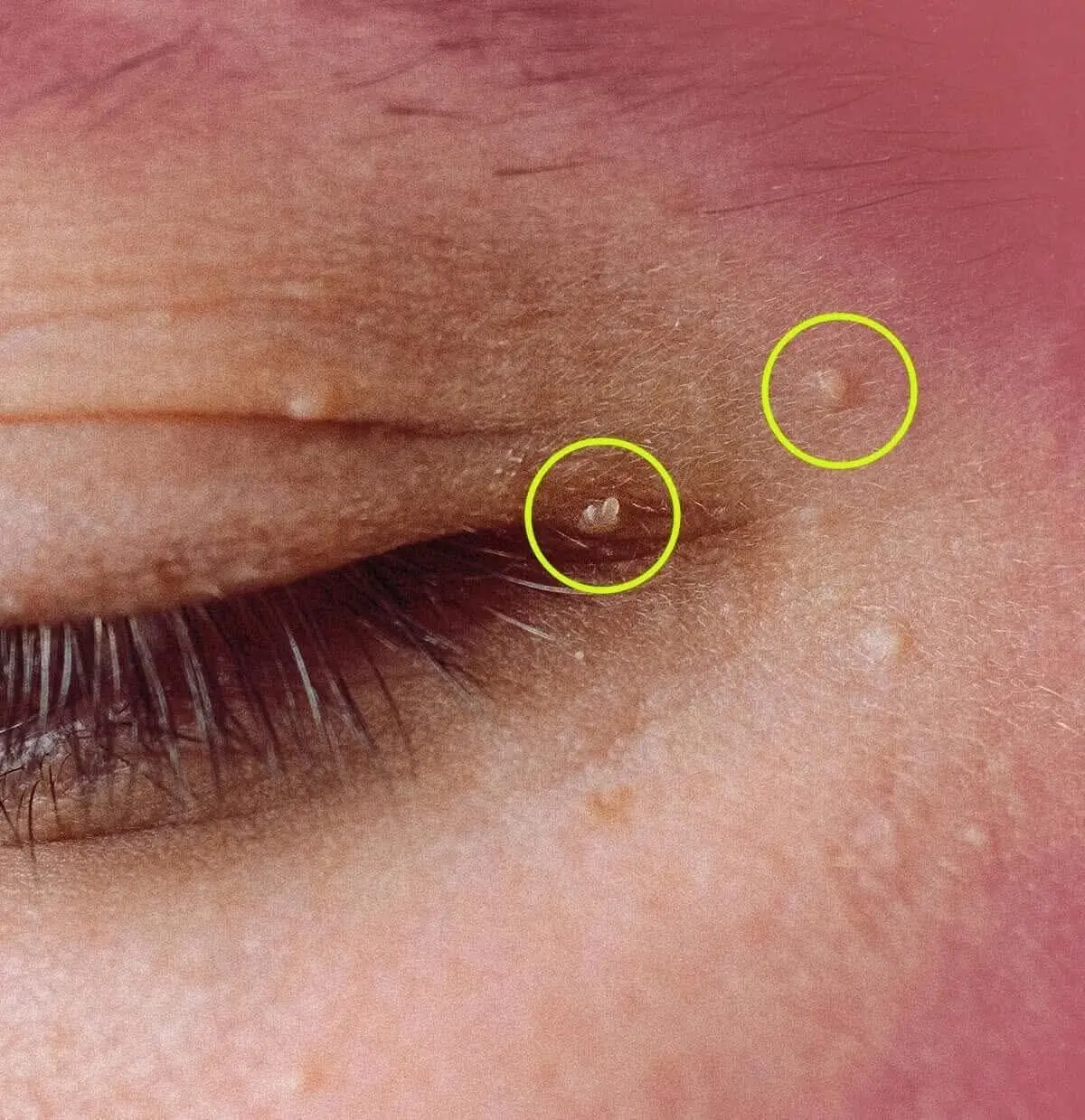 How to Safely Remove Milia