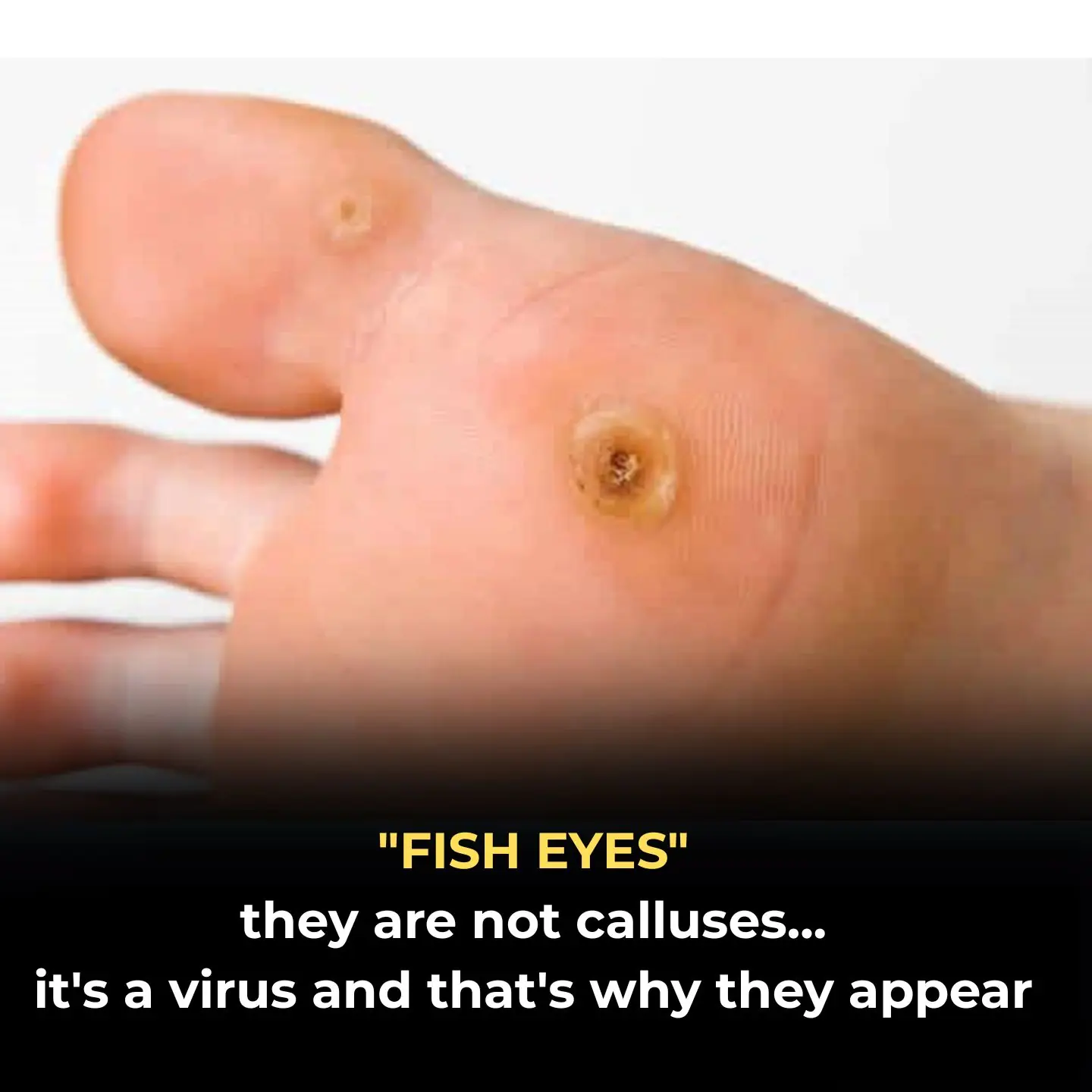 "Fish Eyes" on Your Feet? Why It’s Actually a Virus, Not a Callus