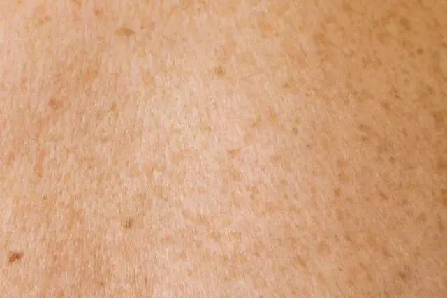 Age Spots: Causes, Prevention, and Effective Treatments