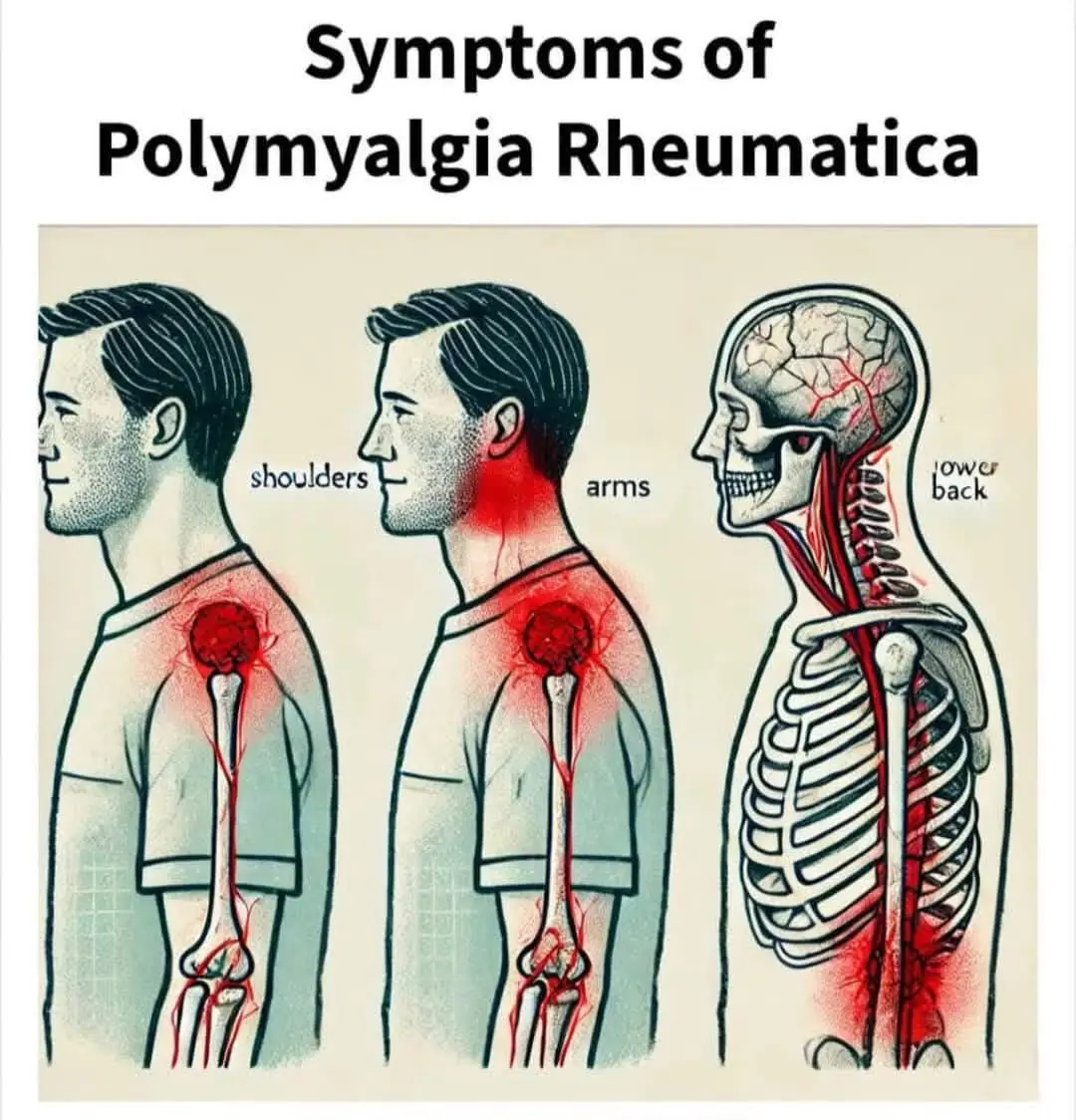 Polymyalgia Rheumatica: Key Symptoms and Indicators