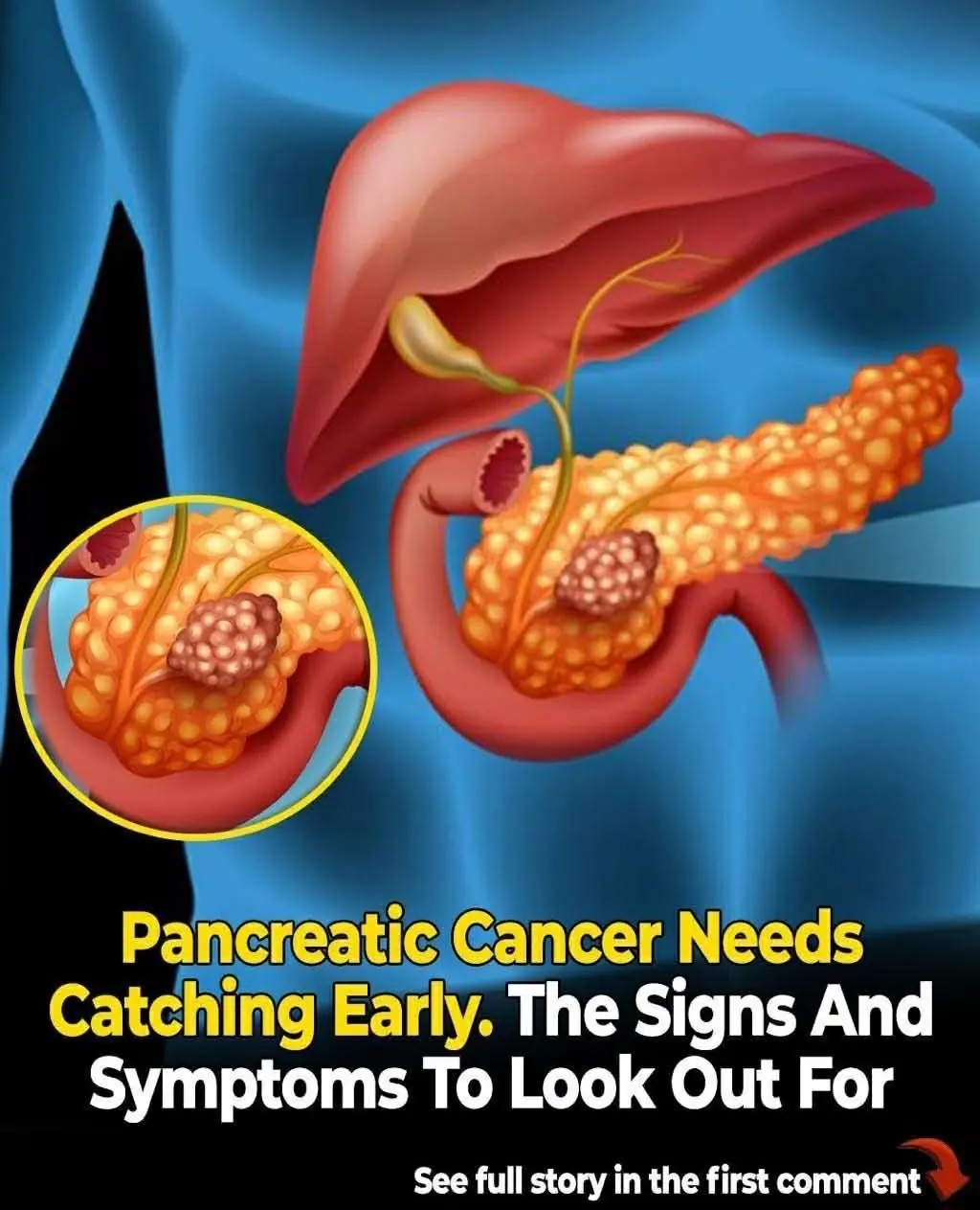 Signs of pancreatic cancer you should never ignore