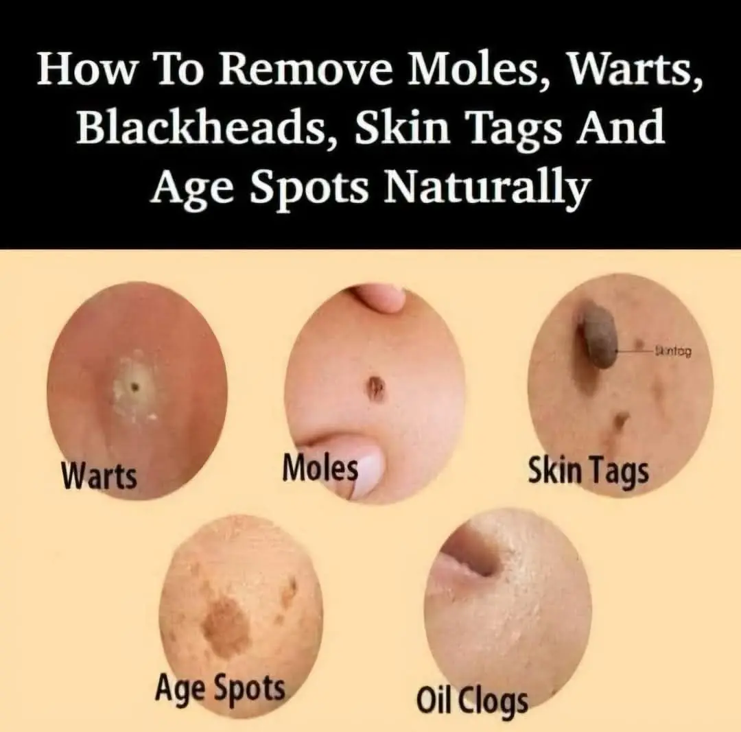 Natural Remedies to Address Skin Tags, Warts, and Blackheads