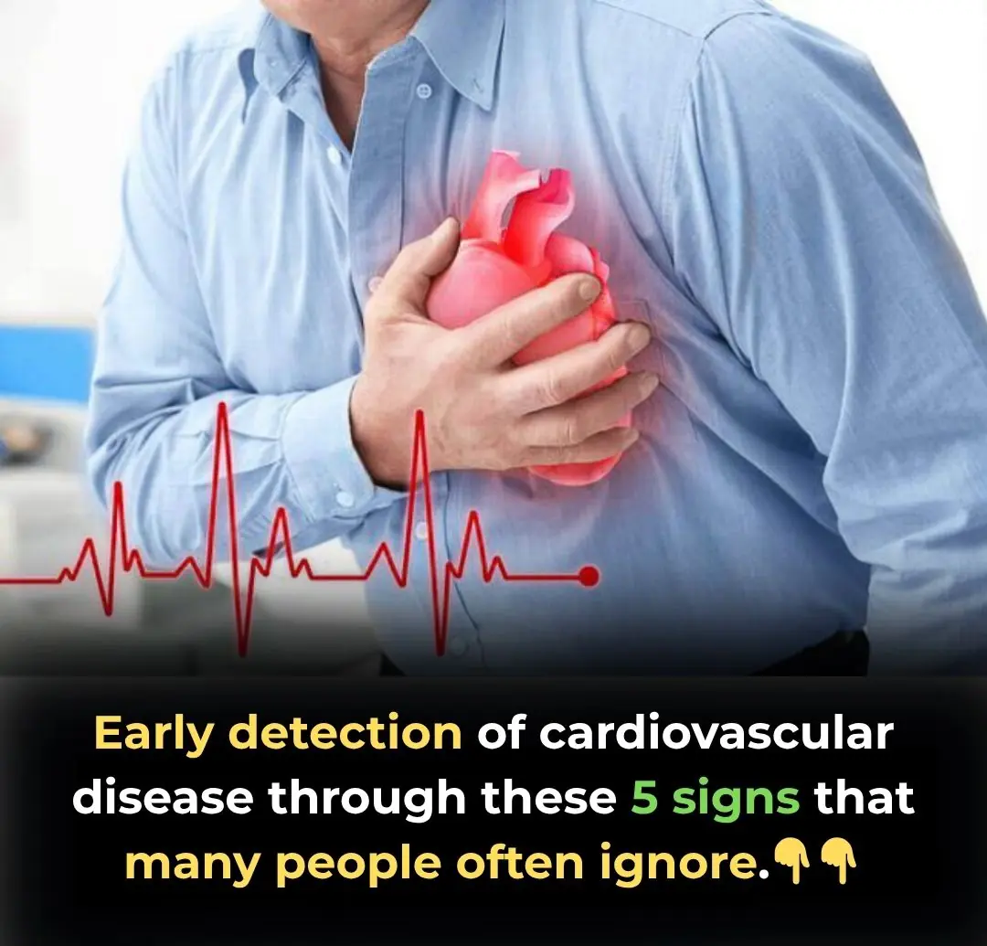 Early detection of cardiovascular disease through these 5 signs that many people often ignore