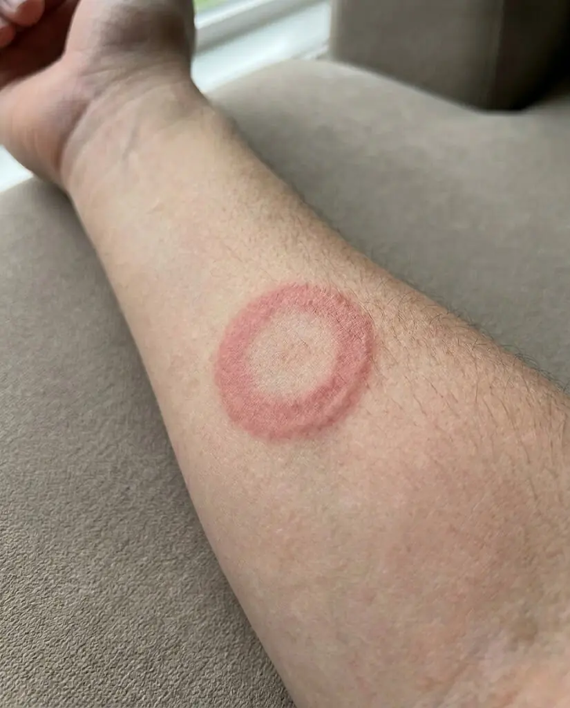 ⚠️ 5 Simple Home Remedies to Prevent Ringworm and Keep Your Skin Healthy