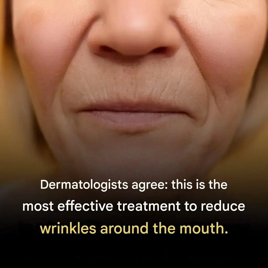 What Really Works for Wrinkles Around the Mouth