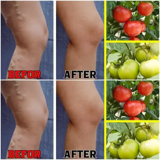 Can Tomatoes Really Help Varicose Veins