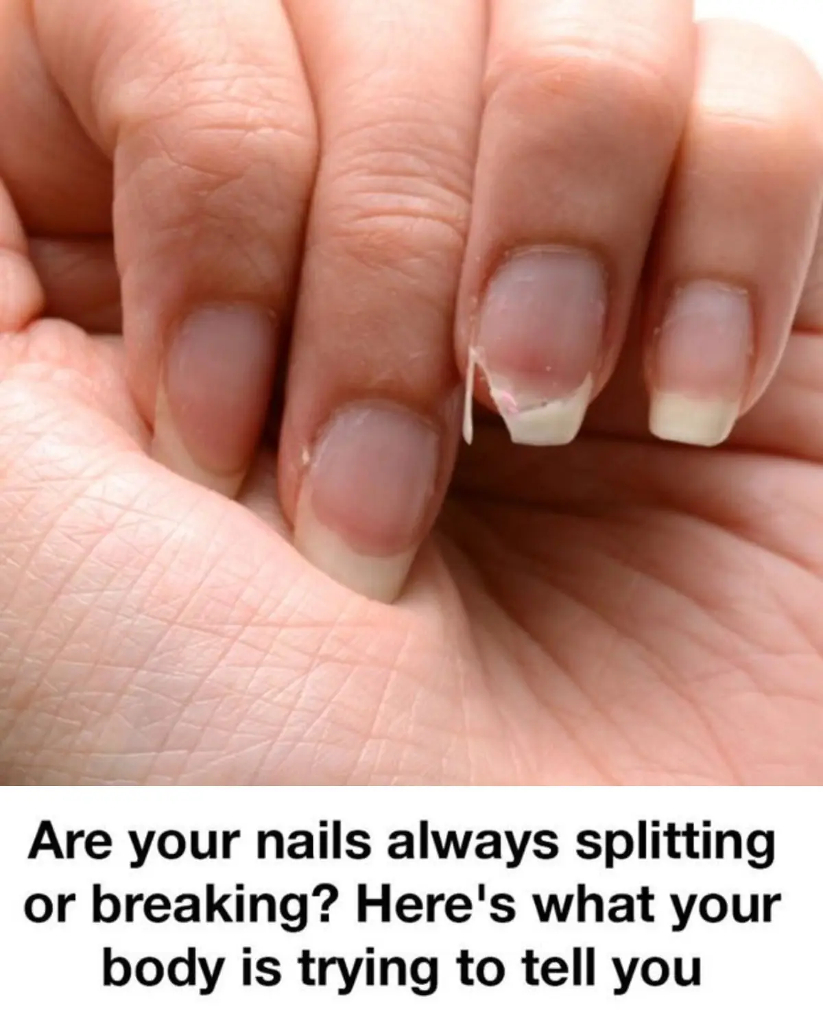 Brittle Nails