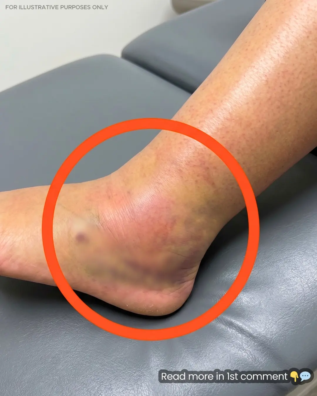 Why Do Older Adults Experience Swollen Legs