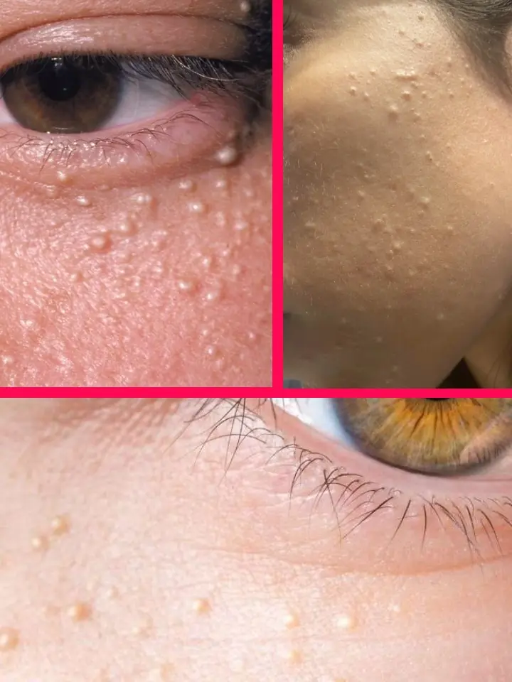 Noticing Small White Bumps on Your Face