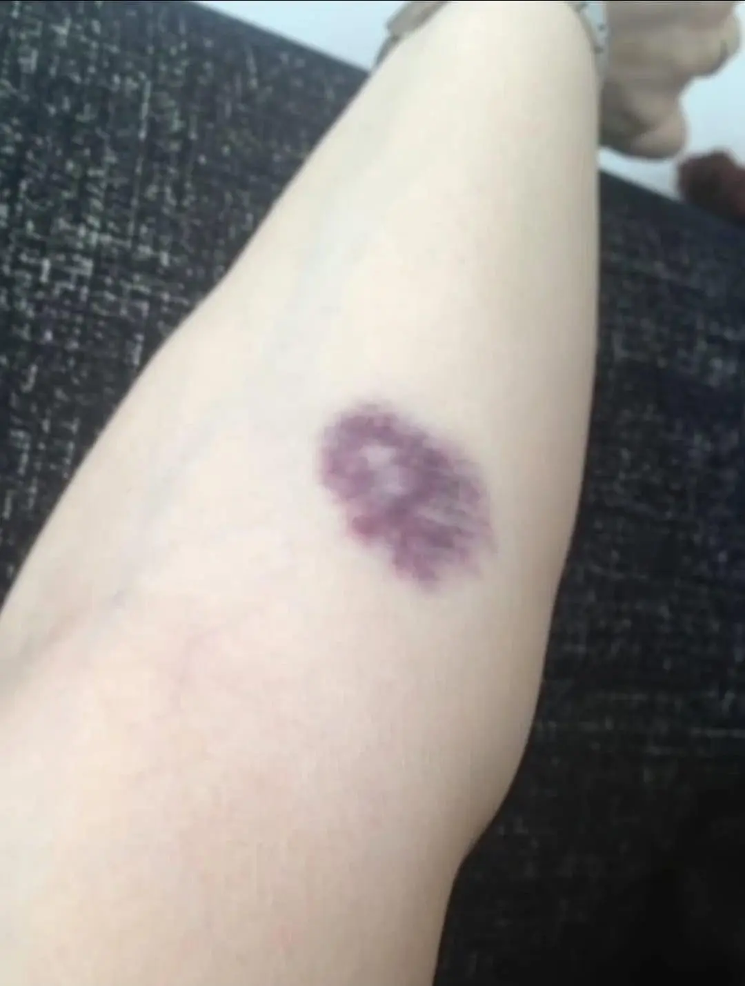 Unexplained Bruising