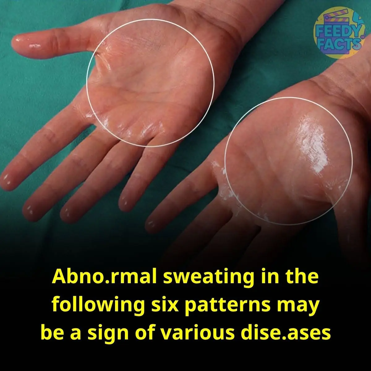Abnormal sweating in the following six patterns may be a sign of various diseases