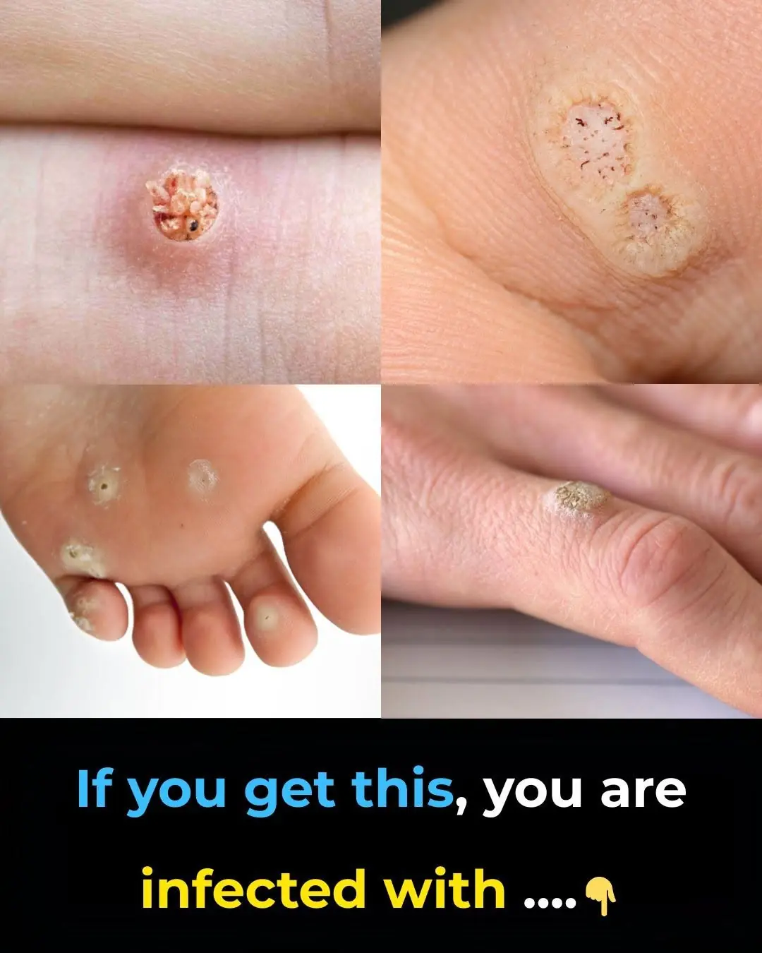 6 Types of Warts (Signs, Symptoms, Home Remedies, and Treatment)