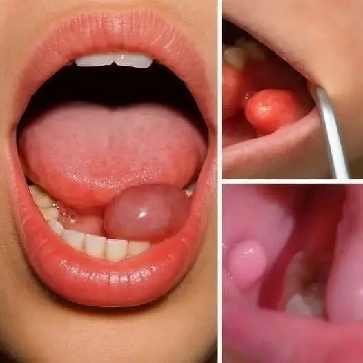 A Small Lump in the Mouth? Here Are the Early Symptoms You Shouldn't Ignore