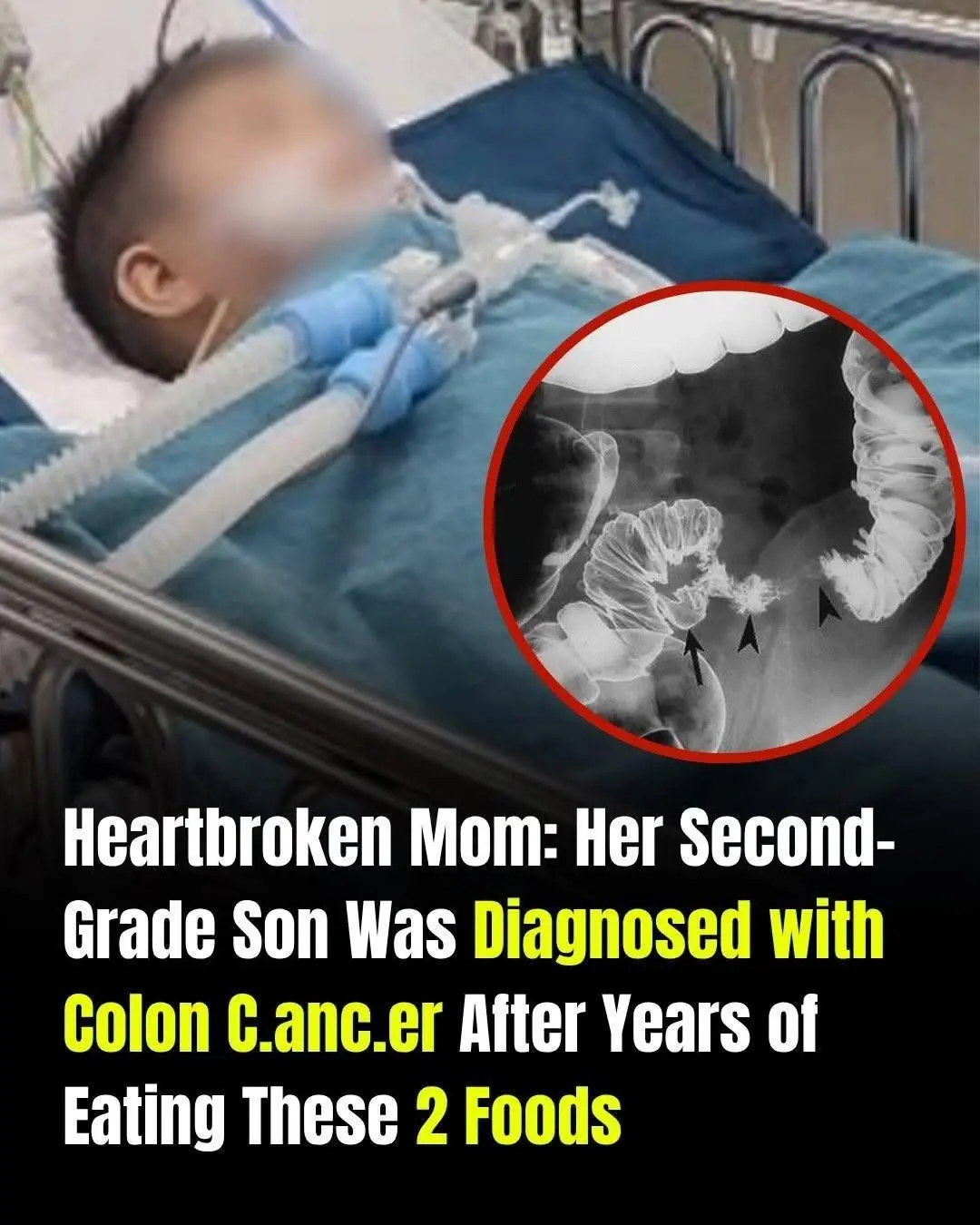 A Mother's Heartbreak: Child Diagnosed With Colon Cancer After Years of Unhealthy Eating Habits