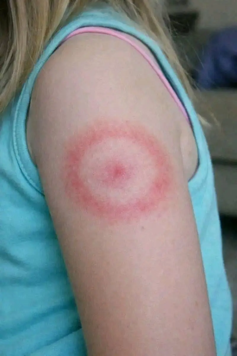 My Daughter Woke Up With a Strange Red Ring on Her Arm: A Parent’s Guide to Ring-Shaped Rashes (And When to Breathe Easy)