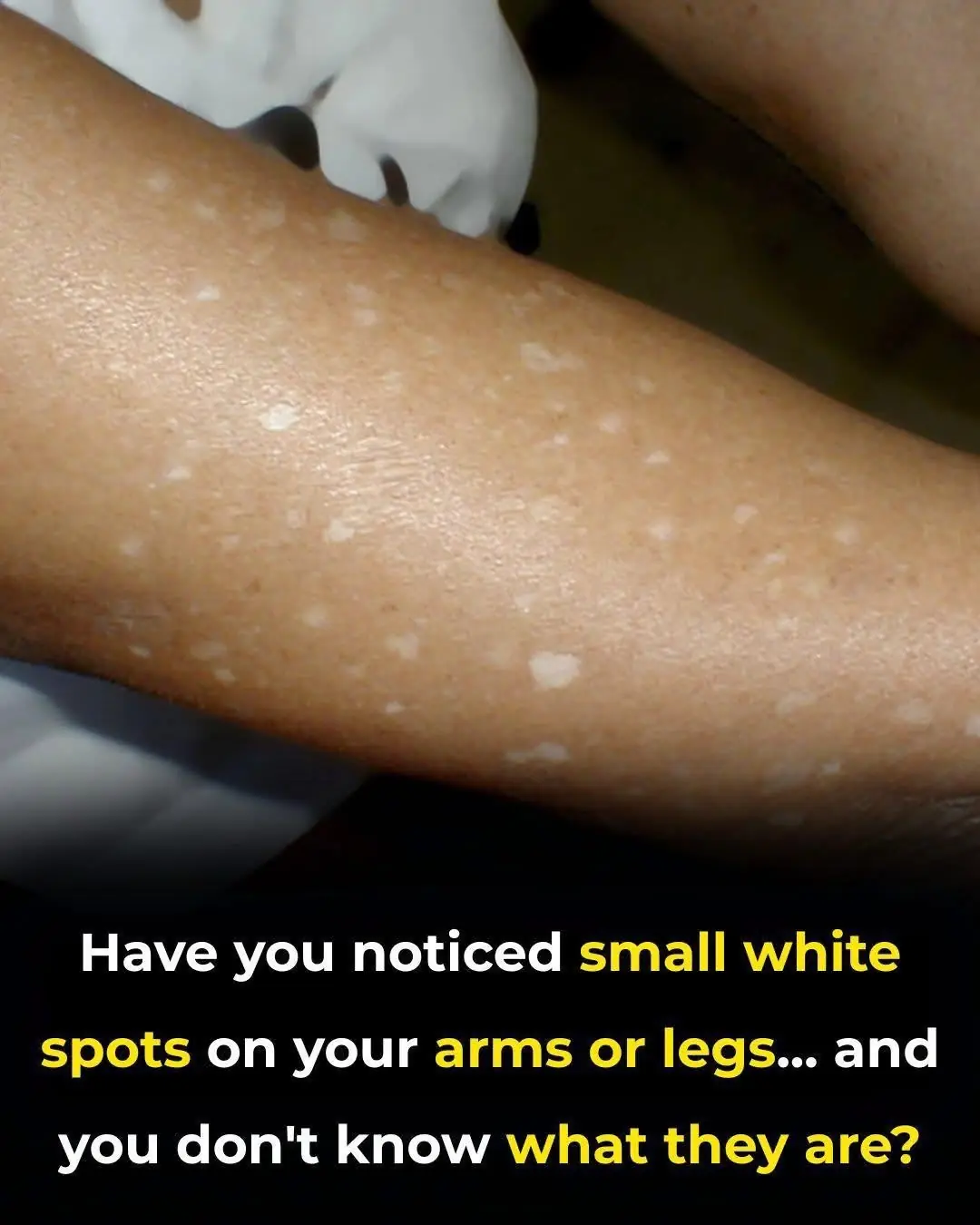 Have you noticed small white spots on your arms or legs… and you don't know what they are?