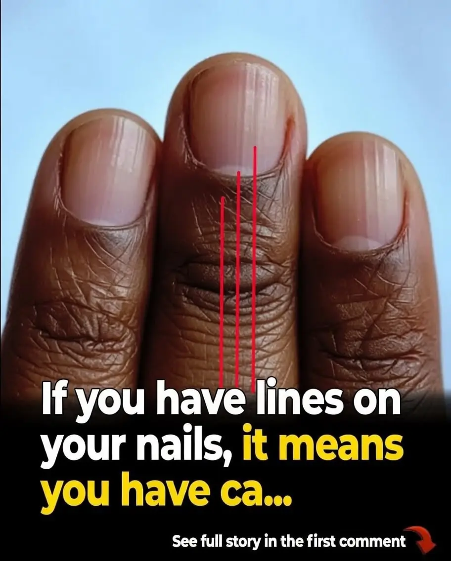 Your Fingernails May Be Sending Health Signals—Don't Miss These Changes